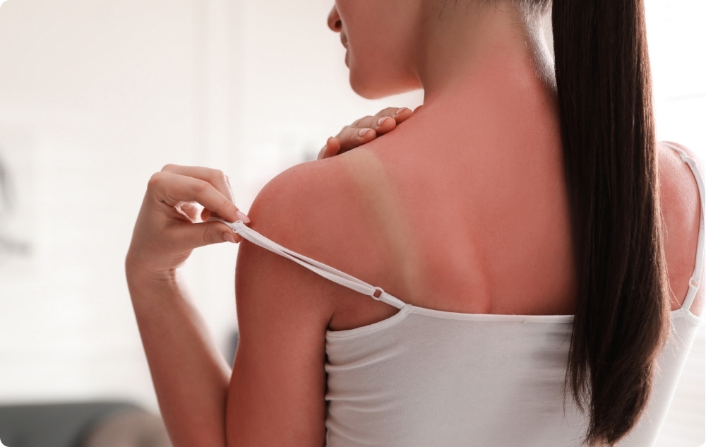 Kaip raminamasis losjonas po deginimosi saulėje