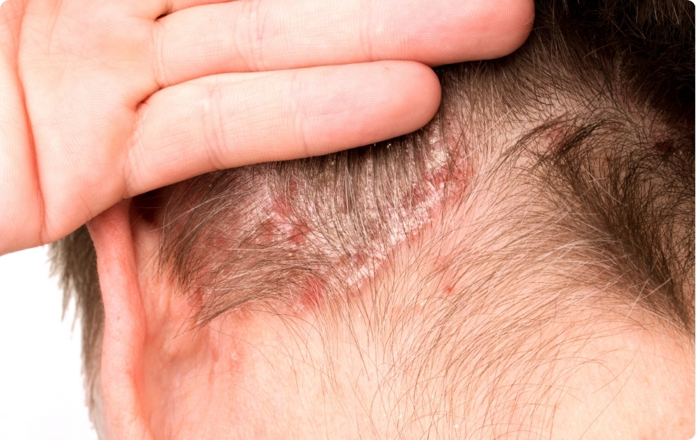 Psoriazė ir kitos odos ligos